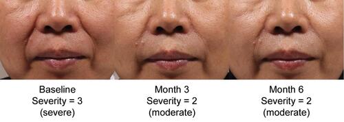 Figure 4 Representative treatment effects: a 49-year-old female subject who received an initial treatment of VYC-17.5L (0.75 mL) in the right NLF and an initial treatment of control product (0.7 mL) in the left NLF.