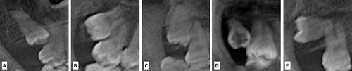 Figure 7 Archer ll classification of upper third molars, (A) mesioangular, (B) distoangular, (C) vertical, (D) buccoangular, (E) horizontal.