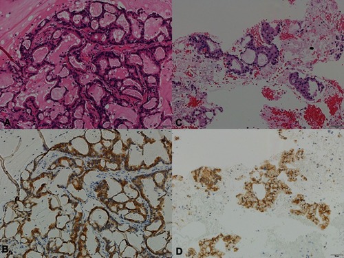 Figure 1 The pathological findings of the primary tumor and ultra-late recurrent tumor. In both the lesions, tumor cells showed glandular structures containing mucin (acinar adenocarcinoma). The histological findings of the primary and recurrent tumors are quite similar. (A) Hematoxylin and eosin staining of the primary tumor (20×). (B) Anti-anaplastic lymphoma kinase (ALK) antibody staining of the primary tumor (20×). (C) Hematoxylin and eosin staining of the recurrent tumor (20×). (D) Anti-anaplastic lymphoma kinase (ALK) antibody staining of the recurrent tumor (20×).