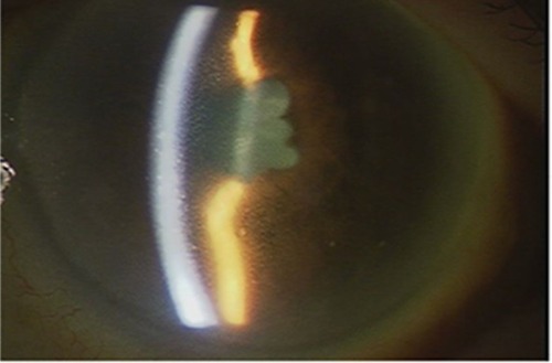 Figure 1 Anterior segment photograph of the left eye.