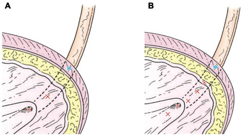 Figure 1 Dextranomer/hyaluronic acid (Dx/HA) injection therapies for primary vesicoureteral reflux. *Extravesical portion of ureter (adjacent to ureteral hiatus). ×: position of needle insertion. (A) Double hydrodistention implantation technique (double HIT). (B) Systematic-multisite hydrodistention implantation technique (SMHIT) These figures show the coronal section of the ureterovesical junction. Multiple Dx/HA injections are sequentially and systematically administered from the proximal to the distal intramural ureter in SMHIT. The coaptation area of the intramural ureter created by Dx/HA bulges can be extended out further by SMHIT than by double HIT.
