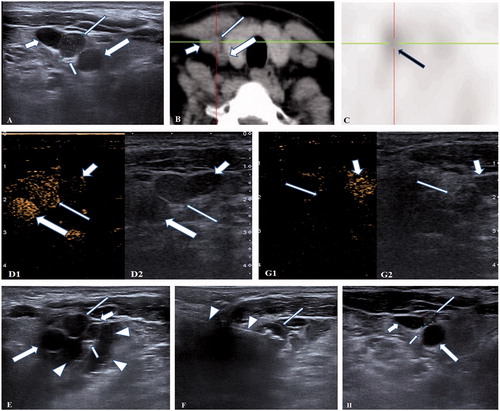 Figure 1. A 47-years-old female patient with a recurrent and ectopic SHPT nodule 2 years after parathyroidectomy was treated by microwave ablation (MWA). (A) A hypoechoic SHPT nodule (long thin arrow) closing to the right sympathetic nerve (short thin arrow) was disclosed to locate between the right carotid artery (long thick arrow) and jugular vein (short thick arrow) in ultrasound. (B) The CT scan showed that the SHPT nodule (long thin arrow) is between the right carotid artery (long thick arrow) and jugular vein (short thick arrow). (C) The SHPT nodule has radioactivity concentration (black arrow) in the late phase on MIBI scan. (D) A uniform hyperenhancement of the SHPT nodule (long thin arrow) between the right carotid artery (long thick arrow) and jugular vein (short thick arrow) was displayed in CEUS preablation. (E) The spacer fluid (white triangle) was injected around the right sympathetic nerve (short thin arrow) behind the right carotid artery (long thick arrow), jugular vein (short thick arrow) and SHPT nodule (long thin arrow) for preventing the nerve from thermal injury during ablation. (F) The hyperechoic signal emerging along the tip of antenna (white triangle) inside the SHPT nodule (long thin arrow) during ablation. (G) A non-enhancement area covered the SHPT nodule (long thin arrow) beside the jugular vein (short thick arrow) after MWA, suggesting complete ablation was achieved by MWA. (H) The SHPT nodule (long thin arrow) in front of right carotid artery (long thick arrow), jugular vein (short thick arrow) and sympathetic nerve (short thin arrow) was obviously shrinking 6 months after MWA in ultrasound.