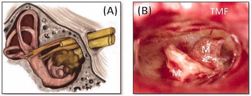 Figure 32. Intracochlear schwannoma (www.intechopen.com) (A) and partially dissected cochlea with a complete schwannoma removal (B) [Citation28]. Image B is a courtesy of Prof. Stefan Plontke, Halle, Germany.