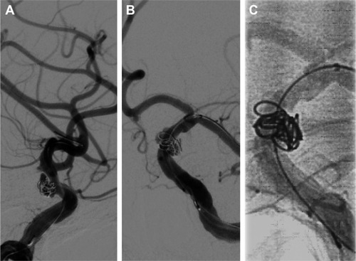 Figure 2 Head DSA images showing the insertion of Target 360 ULTRA coil (5 mm × 15 cm) into the cavity of the aneurysm.