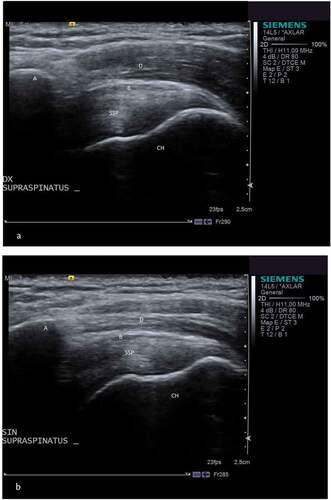 Figure 1. A and b. Ultrasound of both shoulders in a 43 year old female patient with unilateral subacromial pain syndrome.