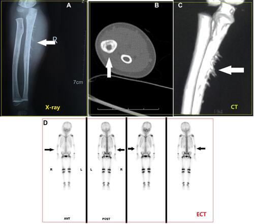 Figure 3 Representative imaging results of case 3 in Table 1. (A) X-ray showed “sun-ray” manifestation. The white arrow indicates the “sun-ray” sign. (B and C) CT showed significant bone destruction. The white arrow indicates bone destruction. (D) Emission computed tomography showed radioactive concentration zone of right ulna. The black arrow shows the radioactive concentration area, indicating the possibility of metastasis.