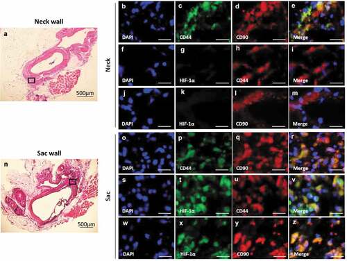 Figure 2. Co-localization of HIF-1α, CD44, and CD90 in the vascular wall. (a) Representative image of the AAA-neck wall with perivascular adipose tissue (PVAT). The squared area is representative area for analysis. Double-immunostaining for CD44 and CD90 (b–e), HIF-1α and CD44 (f–i), and HIF-1α and CD90 (j–m) in the abdominal aortic aneurysm (AAA)-neck wall. (n) Representative image of the AAA-sac wall with PVAT. The squared area is representative area for analysis. Double-immunostaining for CD44 and CD90 (o–r), HIF-1α and CD44 (s–v), and HIF-1α and CD90 (w–z) in the AAA-sac wall. Scale bar = 50 µm. Neck (n = 5) and sac (n = 5) walls.