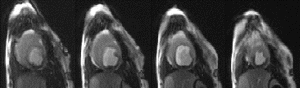 Figure 1. TRUFI+PAT example images from an ischemic dog model showing reduced perfusion in the inferior wall.