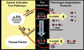 FIGURE 1 Cancer Elevates FDP Levels Through Two Pathways: Coagulation and Fibrinolysis. The AMDL-ELISA DR-70® (FDP) test measures the FDP produced by multiple pathways, unlike other FDP assays which only measure one pathway or one pathway product. Researchers have established that cancer causes elevated levels of both urokinase-type plasminogen activator (u-PA)[ Citation23-25 ] and tissue factor (TF).[ Citation26-28 ] Both the u-PA and TF pathways effect the production of FDP in cancer cells. The u-PA pathway (1A and 1B) activates plasmin by transforming plasminogen, the inactive precursor of plasmin, into functional plasmin.[ Citation23-25 ] The TF pathway (2) alters the extrinsic coagulation system causing an activation of thrombin.[ Citation26-29 ] Thrombin (3) converts Fibrinogen to Fibrin.[ Citation 30 ] The type of FDP produced will be different depending upon which of the two substrates is digested by plasmin. When fibrinogen is the substrate for plasmin (4), fragments D and E are the end products with fragments X and Y as intermediate products in this digestion. When fibrin is the substrate of plasmin (5), D-dimer is the end product. As a result of either pathway (4) or (5), cancer will cause an elevation in FDP levels as measured by the DR-70 (FDP). Tests that measure only one of the individual FDP species, i.e., D-dimer tests, will miss up to half of the FDP generated as a result of cancer physiology.