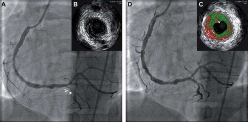 Figure 1. (A) Coronary angiography showing diffuse atherosclerosis in RCA with site of plaque rupture denoted by small arrowheads (>). (B) Grey-scale IVUS showing plaque rupture at proximal PDA (inset). (C) VH assessment of mid-distal RCA showing large amount of necrotic core (inset). (D) Coronary angiography of RCA after POBA of PDA.