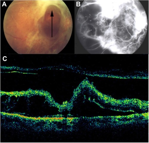 Figure 32 (A) Fundus photography, (B) fluorescein angiogram, and (C) Stratus optical coherence tomography of proliferative diabetic retinopathy with preretinal membranes (thin, reflective bands anterior to the retina) and cystoid macular edema.