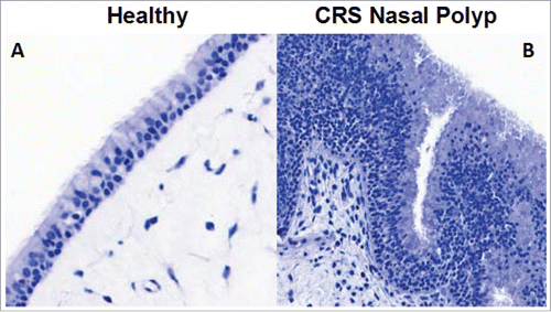 Figure 1. Epithelial morphology is abnormal in nasal polyps from CRS patients. Healthy nasal epithelium is a highly organized structure with undifferentiated progenitor cells along the basement membrane, and the differentiated cells, ciliated and goblet cells along the apical edge (A). However, in CRS the epithelium often has a large expansion of basal cells and is highly disorganized, which could lead to barrier dysfunction (B).