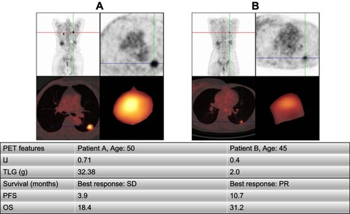 Figure 3 Examples of patient analysis.Abbreviations: LI, lung index; TLG, total lesion glycolysis; PFS, progression-free survival; OS, overall survival; PR, partial response; SD, stable disease .