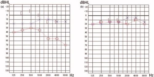Figure 2. Pure tone audiometry. (a) Before surgery, conductive hearing loss of the right ear was observed. (b) After surgery, the right air-bone gap completely disappeared.