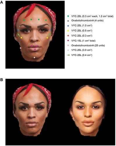 Figure 3 Full-face transition of a 25-year-old male-to-female transgender patient who received onabotulinumtoxinA and dermal fillers to feminize the face. (A) Colored dots and arrows indicate injection points with corresponding concentrations of onabotulinumtoxinA or filler injected. (B) The patient before (left) and 3 months after (right) treatment. Patient images provided by Vincent Wong, MD.