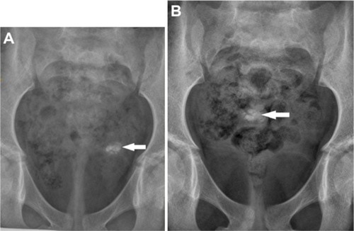 Figure 1 Abdominal plain X-rays showing an oval calcific opacity.