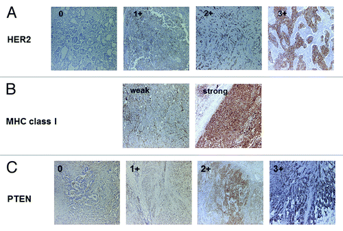 Figure 1. Representative immunostaining of HER2, MHC class I and PTEN. (A) HER2 staining (0, 1+, 2+, 3+). (B) MHC class I staining (weak and strong). (C) PTEN staining (0, 1+, 2+, 3+). Original magnification: 200x.