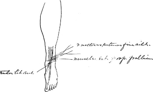 Figure 2. Part of Cushing's operative illustrations documenting the tendon transfer procedures. Case 2. The extensor proprius pollicis was removed from its distal attachment, and sutured to the tendon tibialis anterior.