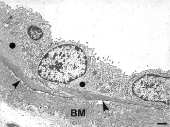 FIG. 9 TEM of three squamous parietal cells showing bundles of filaments in basal cytoplasm (arrowheads). Less conspicuous and globular aggregates of filaments are also present in other zones of the cytoplasm (circle). Note the presence of microvilli in the apical surface of these cells. The basement membrane (BM) is thickened with abundant amorphous material and numerous matrix vesicles. Bar = 700 nm.