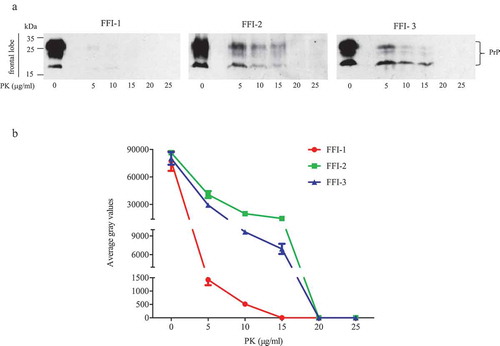 Figure 1. PK-resistances of PrPSc in the frontal lobe of 3 FFI patients. (a). Western blot of BH digested by 0, 5, 10, 15, 20 and 25 μg/ml of PK at 37°C for 60 min. (b). Quantitative analyses of each grey numerical value of PrP blots. Data shown were means ± SD of triplicate samples. Student’s t-test was used for statistical analyses.