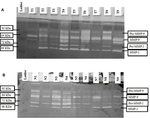 Figure 2 Matrix metalloproteinases zymogram in breast cancer tissue specimens. A 20 µg of tumor (A) and adjacent normal (B) breast tissue from breast cancer patient biopsies were loaded for zymography. Pro-MMP-9 band is visible at 92 kDa, MMP-9 at 84 kDa, pro-MMP-2 at 72 kDa and MMP-2 at 68 kDa.
