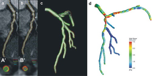 Figure 3. A case example that highlights the role of CTCA in assessing plaque morphology and physiology.The raw CTCA data demonstrates two tight lipid-rich lesions in the ostium (a) and the proximal segment (b) of the left anterior descending artery. Panels (a‘) and (b’) portray the cross sections with the minimal lumen area, their locations in panels (a) and (b) are indicated with asterisks. The annotated borders in the CTCA were used to reconstruct coronary artery anatomy, (c) assess the distribution of the plaque in the model (red indicates lipid tissue, green fibrotic, light-green fibrofatty and white calcific tissue) and perform blood flow simulation, estimate the local hemodynamic forces and their association with plaque morphology (d). Full color available online.