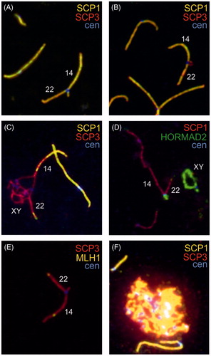 Figure 1. Immunofluorescent analysis of spermatocytes. (A) Closed trivalent showing heterologous synapsis between the p-arms of the acrocentric chromosomes 14 and 22. (B) Open trivalent showing unsynapsed p-arms of acrocentric chromosomes 14 and 22 in the cis position. (C) An association between the trivalent and the sex chromosomes. (D) HORMAD2 staining of p-arms of acrocentric chromosomes 14 and 22 and on sex chromosomes. (E) Closed trivalent showing MLH1 foci. (F) A pachytene spermatocyte showing aberrant synaptonemal complex morphology compared with normal bivalents. SCP1: synaptonemal complex protein 1; SCP3: synaptonemal complex protein 3; cen: centromeres.