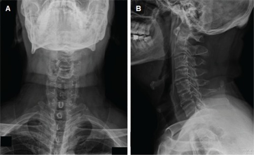 Figure 1 X-ray of the cervical spine anterior–posterior (A) and lateral (B) views showed a mild narrowing of intervertebral disk spaces at almost every level of the cervical spine and osteoarthrosis of several apophyseal joints.