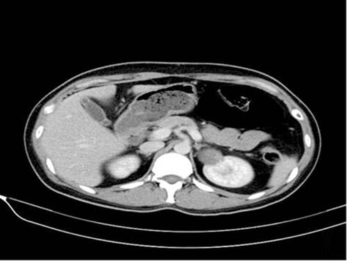 Figure 1 Computed tomographic imaging: The enhanced computed tomographic (CT) scan revealed a mass of 30×40 mm in the upper pole of left renal that was classified as Bosniak category IV.