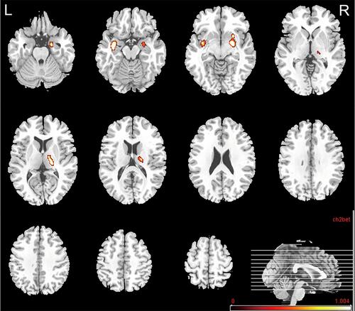 Figure 3 Abnormal glucose uptake in the death group compared with the survival group. The PET findings were superimposed on an MRI template to facilitate accurate identification of the affected structures. The cerebral glucose metabolism displayed with red-to-white color was significantly higher in the bilateral amygdala, bilateral putamen, left thalamus, and left uncus (p<0.001). No significantly lower metabolism was found. Color bar indicates t-values.