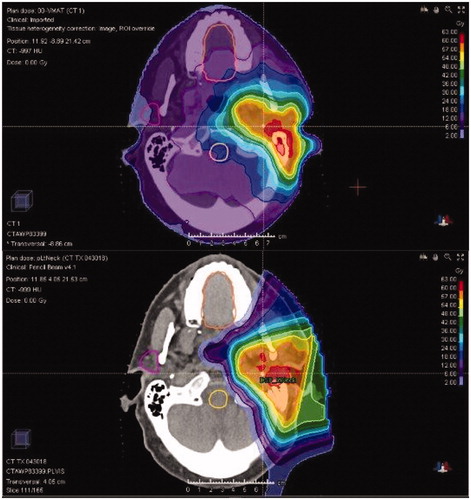 Figure 1. Improved normal tissue sparing with proton beam therapy (bottom) versus intensity-modulated radiation therapy (top) in a patient treated for a parotid gland tumor.