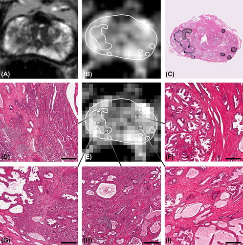 Figure 2. Patient example, showing the broad difference in histology among voxels with an ADC of 1.2 × 10−3 mm2/s. A) T2w image, B) high resolution ADC map, C) corresponding H&E section with delineated tumour. The dominant tumour had a Gleason score 4 + 5 = 9, striped tumour areas consisted of Gleason grade 3. D), G) and H) tumour voxels. F) central gland voxels containing benign prostatic hyperplasia. I) voxel with normal peripheral zone tissue. Bars: 200 μm.