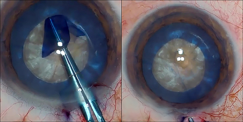 Figure 4 Capsulorhexis of approximately 5mm performed with micro-capsulorhexis forceps.