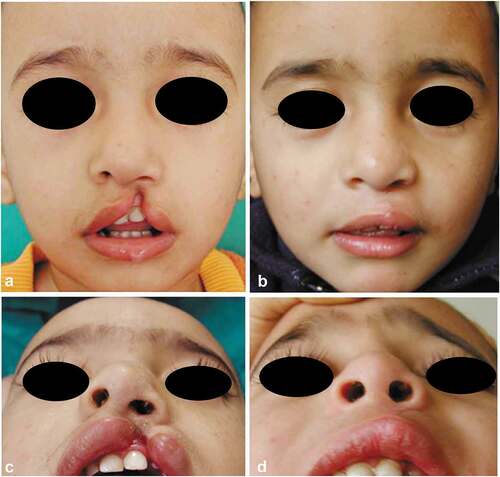 Figure 13. A case of Millard’s group; 5-month-old male, with left-sided unilateral incomplete cleft lip. (a and c) Preoperative frontal and submental views and (b and d) 4 months’ postoperative frontal and submental views