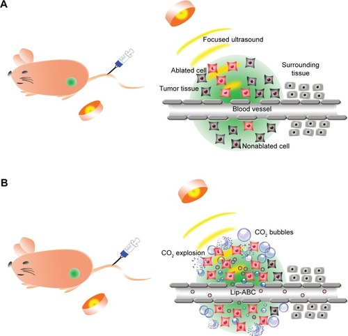 Figure 6 Schematic illustration of HIFU tumor ablation and Lip-ABC synergizing HIFU tumor ablation.Notes: (A) Schematic illustration of HIFU tumor ablation. (B) Schematic illustration of Lip-ABC synergizing HIFU tumor ablation.Abbreviations: HIFU, high-intensity focused ultrasound; Lip-ABC, liposomes containing ammonium bicarbonate.