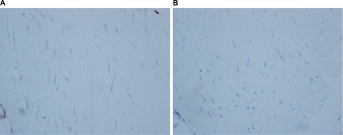 Figure 4 Immunohistochemistry demonstrating negative CD34 (A) and desmin (B).