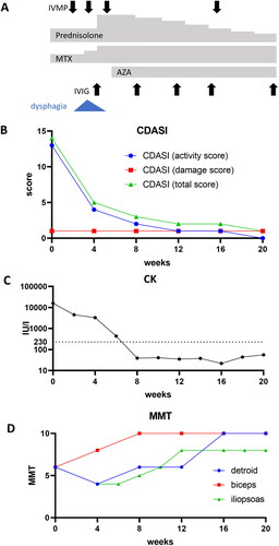 Figure 1. Clinical course of treatment and disease activity in the juvenile patient with anti-nuclear matrix protein 2 (NXP2) antibody-positive dermatomyositis (DM). (A–D) treatment course and dysphagia (a), and transitions in cutaneous dermatomyositis disease area and severity index (CDASI, B), the serum creatine kinase (CK) level (C), and manual muscle testing (MMT) of deltoid, biceps, and iliopsoas (D). IVMP: intravenous methylprednisolone pulse therapy; MTX: methotrexate; AZP: azathioprine; IVIG: intravenous immunoglobulin.