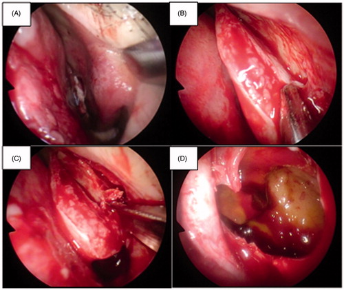 Figure 4. Endoscopic views during surgery. These pictures correspond to Figure 3.