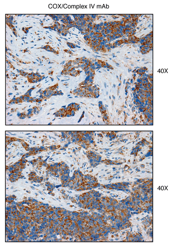 Figure 16 Complex IV (MT-CO1), a component of the respiratory chain, is preferentially expressed in human epithelial cancer cells, in breast cancer patients. Paraffin-embedded sections of human breast cancer samples lacking stromal Cav-1 were immuno-stained with antibodies directed against Complex IV (MT-CO1) (brown color). Slides were then counter-stained with hematoxylin (blue color). Note that Complex IV is highly expressed in the epithelial compartment of human breast cancers that lack stromal Cav-1. Two representative images are shown. Original magnification, 40x, as indicated.