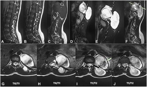 Figure 1 MRI scan sagittal and axial planes; (A–C) Sagittal T1WI demonstrated iso-intense intradural extramedullary lesion at different cuts from right to left; posterior scalloping of T11, (D) T2WI sagittal demonstrated heterogeneous mild hyper intensity of the lesion, (E) T2-STIR sagittal demonstrated homogenous marked hyper-intensity, (F) Post gadolinium sagittal demonstrated heterogeneous slight hyperintensity and well-enhanced rim (white arrow), G–J) Post enhanced axial demonstrated the extent of mass from T10/T11 disc (G and H) to T11/T12 disc (I and J). The mass lesion exited the left neural exit foramina of T11-T12 (black arrow, I). The lesion pulled the content of spinal canal towards itself (G and H). The well-enhanced rim was clearly demonstrated (white arrow, I).