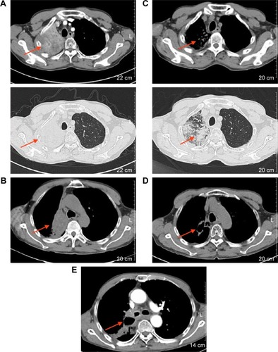 Figure 2 Chest CT images.