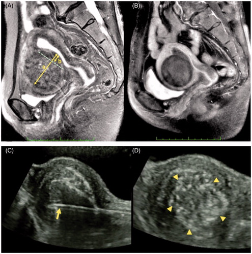 Figure 3. (A) A T2-weighted magnetic resonance image (MRI) of a submucosal myoma with low protrusion ratio (b/a = 20%) before ablation. Arrows a and b represent a diameter and a protrusion part of a submucosal myoma, respectively. The b/a represents the protrusion ratio. (B) A gadolinium-enhanced T1-weighted MRI of a submucosal myoma 1 month after MEA with TCMM is shown. The necrotic change in the myoma is depicted as a de novo avascular area. (C) A photograph of a straight microwave applicator 4 mm in diameter with a conical end (arrow) which has been inserted into the myoma. The transcervical puncture line is maintained within the transabdominal ultrasound imaging plane in real time. (D) The echogenicity of the myoma was increased and a change to a mottled pattern (triangles) in the myoma tissue was observed after microwave irradiation.