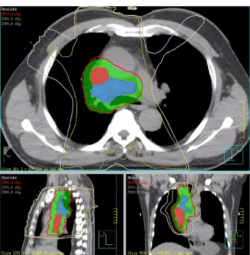 Figure 2 Dose distribution in the primary intensity-modulated radiation therapy. The red, olive, and grey lines represent dose distributions of 66, 30, and 20 Gy, respectively. The red, blue, and green areas represent malignant thrombosis in the superior vena cava, metastatic lymph nodes, and the planning target volume, respectively.