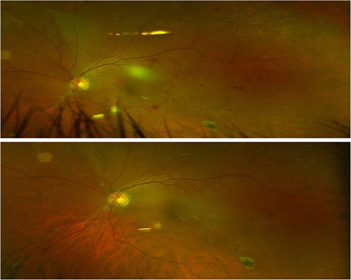 Figure 3 DRSS pre- and post-PBM. A selected patient showing a one-step improvement in DRSS scoring from 47 (moderate DR) to 43. Significant reduction of hemorrhage and IRMAs is seen in color fundus imaging from Baseline (top) after PBM treatment (bottom) at Month 1. The CVA slightly increased from 0.08 ± 0.12 to 0.06 ± 0.08 (logMAR).