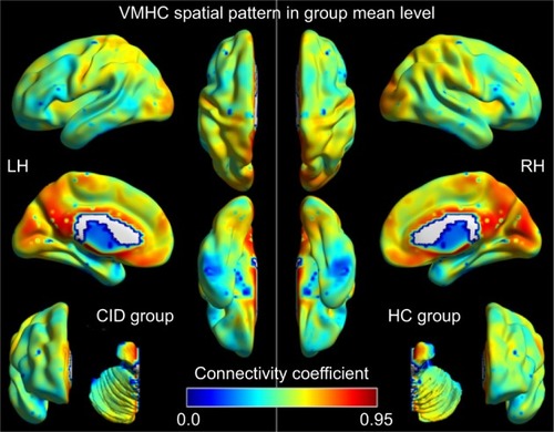 Figure 2 VMHC spatial patterns at the group mean level of the CID and HC groups. The warm color tone indicates higher homotopic connectivity coefficients.