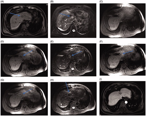 Figure 5. Small HCC in the hepatic dome of a 46-year-old man treated with MR-guided RFA. (A–B) The lesion in segment IV (arrow) is 21 mm in diameter and appears hypointense in T1WI (arrow, A) and hyperintense in T2WI (arrow, B) before RFA. (C) The RF multitined electrodes are expanded to overlap the lesion without penetrating the diaphragm and pericardium. (D–E) After the first RFA, the lesion is immediately overlapped partially by the rim of hyperintensity on 3D-T1WI and hypointensity on T2WI. The residual tumor of the left side still appears hypointense in T1WI (arrow in D) and hyperintense in T2WI (arrow in E) as pre-RFA. (F) A second ablation is performed after replacement of electrodes (arrow). (G, H) A typical ‘target sign’ (arrow in G) is clearly shown in the ablative zone on T1WI and appears hypointense in T2WI (arrow, H) immediately after RFA. (I) The ablative zone assimilated and without enhancement in MRI after 22-month follow-up.