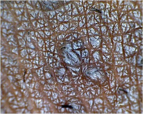 Figure 3 Transfollicular penetration.