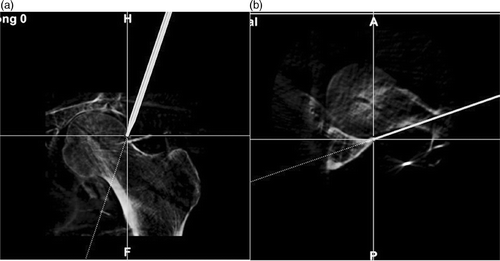 Figure 6. Visual assessment of navigation accuracy was performed by indicating several landmarks with the navigation probe. Mutiplanar images of the head-neck junction of the femur (a) and posterior acetabular edge (b) are shown.