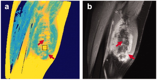 Figure 3. Comparison of a sagittal T2 map (a) with post-treatment postcontrast image (b) of same location for patient 1. The nonperfused volume (NPV) appears hyperintense on T2 maps (example given by ROI box). Consequently, the red arrows identify gaps in the NPV, which correspond to high enhancement in the postcontrast images.