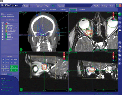 Figure 3. CyberKnife radiosurgery treatment planning for a right ONSM. This patient was a 28-year-old female presenting with progressive deterioration of visual fields and acuity in the right eye over the previous 6 months. (a) Optic nerve imaging was performed using 3-T MR (Siemens Trio). CT-MR fusion was performed on the CyberKnife treatment planning station. The nerve was identified as a loop displaced downward by the tumor and was drawn as a critical structure. This enhanced the degree of nerve sparing from irradiation. (b) A total of 109 beams were delivered non-isocentrically to the lesion. Treatment volume was 0.764 cc. A total dose of 20 Gy prescribed to the 70% isodose was delivered in 4 stages (with 5 Gy per stage) separated by an interval of 24 hours. Maximum dose was 28.57 Gy. Tumor and optic nerve dose volume histograms (DVHs) show a substantial sparing of the optic nerve.